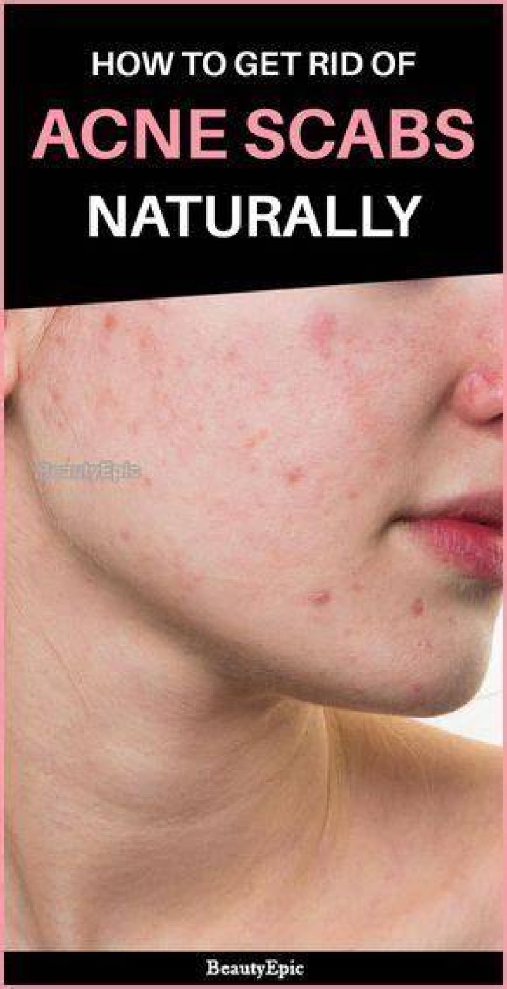 How to get rid of pimple scabs