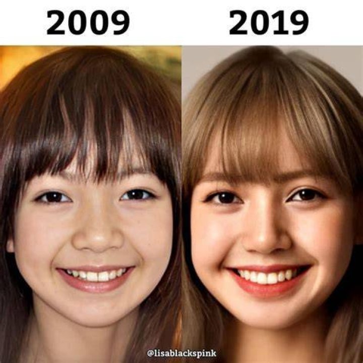 Lisa BlackPink Plastic Surgery : Before and After